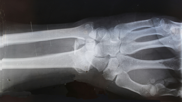 x-ray_bones_arm_hand_unsplash